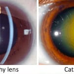What are Cataracts