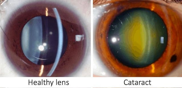 What are Cataracts